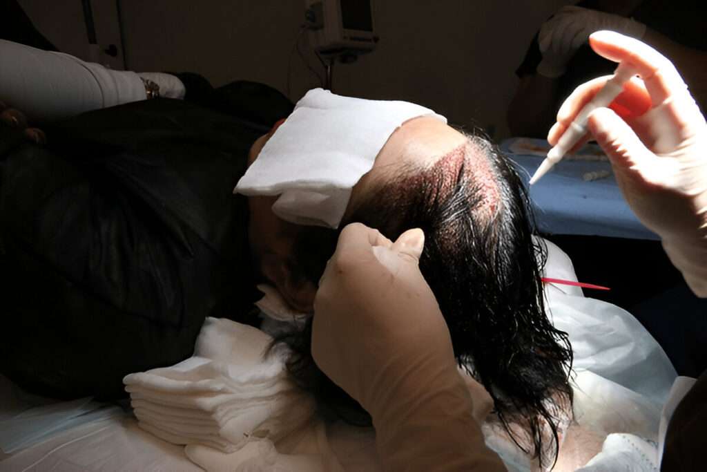 best hair transplant London