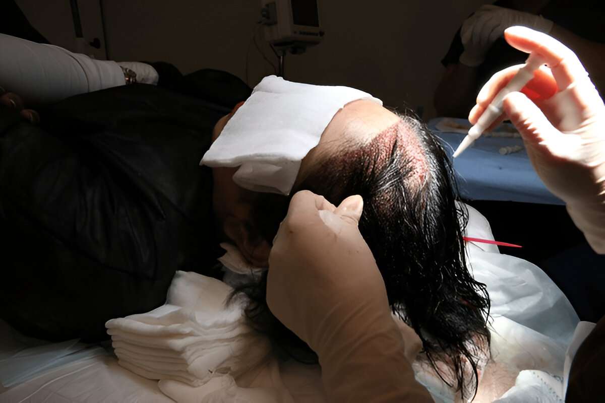 How to Choose the Right Hair Transplant Surgeon in London