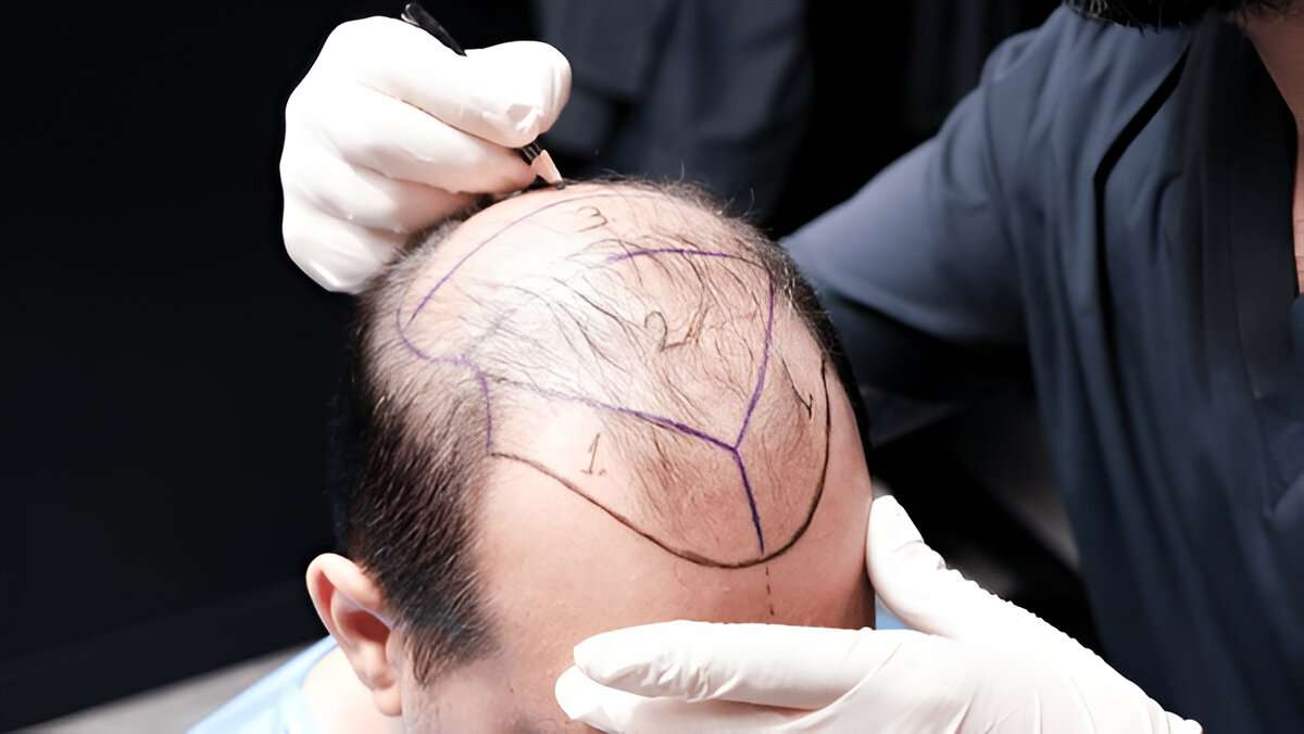 How Much Does a Hair Transplant Cost in the UK?