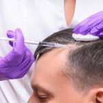 hair transplant