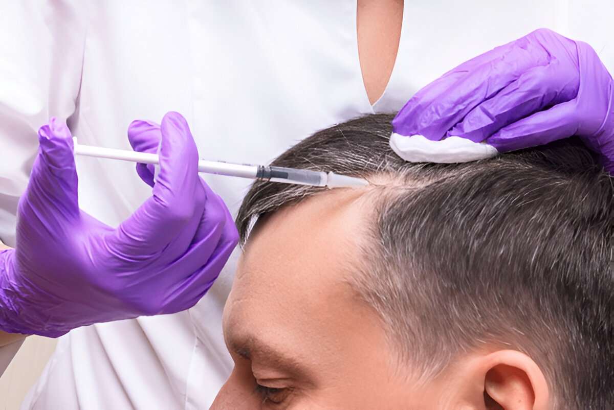 hair transplant