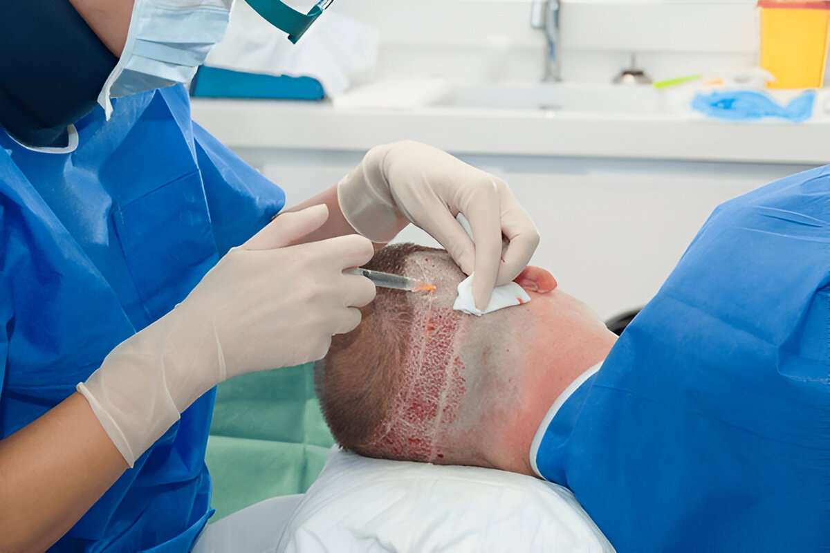 How to Manage Expectations After a Hair Transplant in the UK