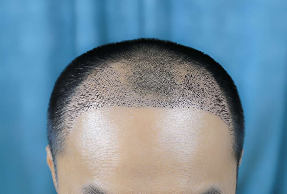 How to Achieve the Best Hair Transplant Results in London