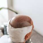 Hair Transplant
