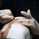 Hair Transplant