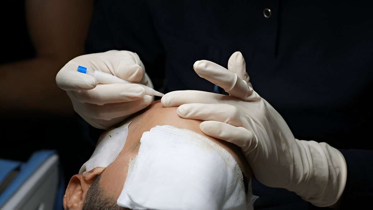 Hair Transplant