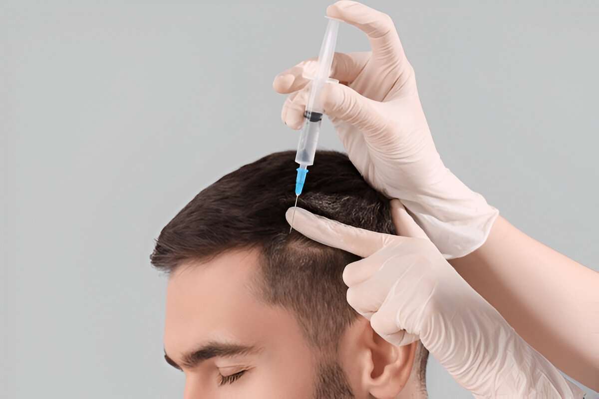 hair transplant cost London