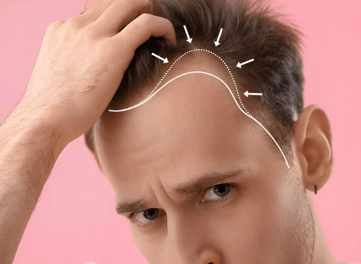 The Most Effective Hair Transplant Methods Explained