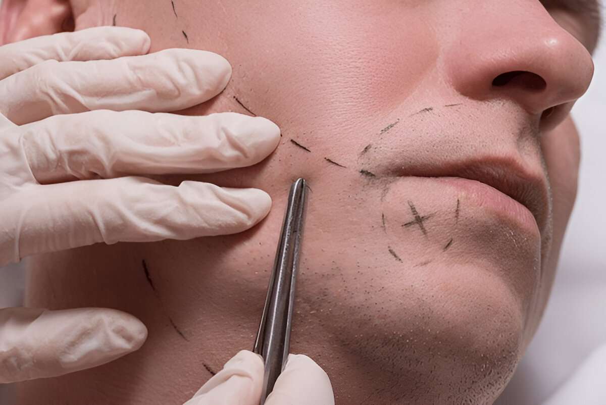 How Much Hair Do You Need for a Successful Transplant