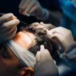 Hair Transplant