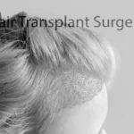 Hair Transplant
