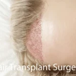 Hair Transplant