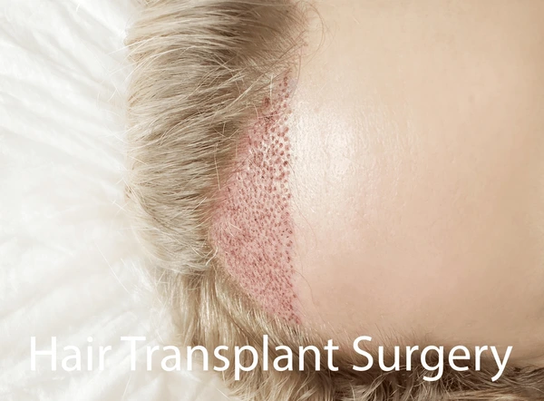 Hair Transplant