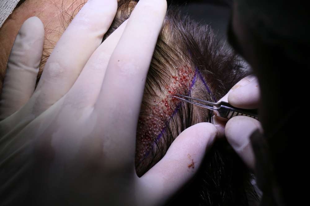 Rob Brydon Hair Transplant: Stunning Before and After