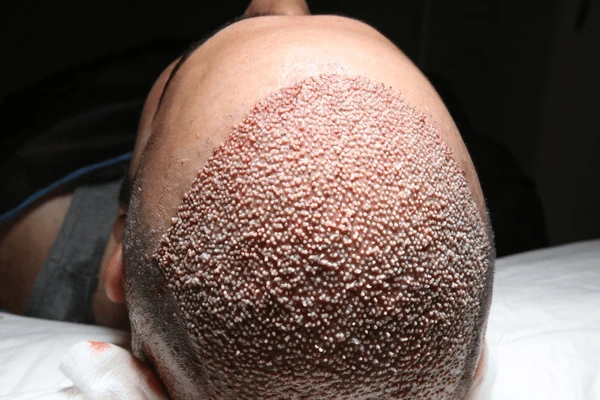 hair loss treatment