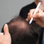 Jude Law hair transplant