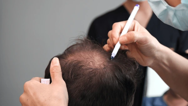 Jude Law hair transplant