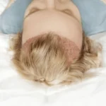 Gordon Ramsay hair transplant before and after