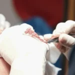 oral minoxidil UK