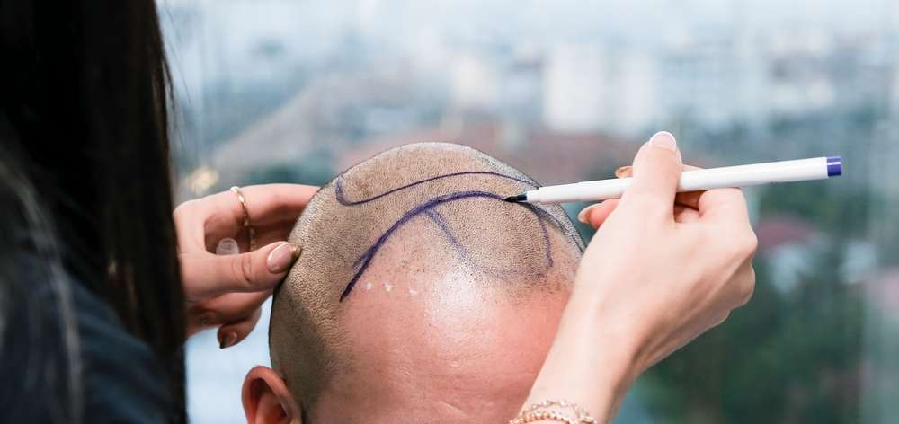 Stop Combing It Forward: Better Hairline Fixes